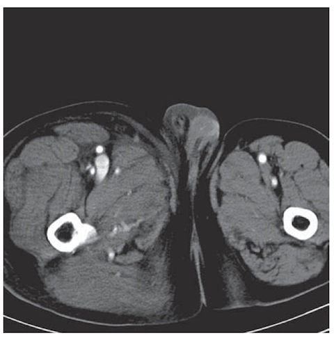 Aneurysm rupture into alarge vein — case reports