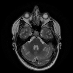 Recurrent cerebrovascular accidents in young man with patent foramen ovale and thrombophilia