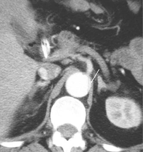 Piorunujące niedokrwienie trzewi wprzebiegu ostrego rozwarstwienia aorty typu B