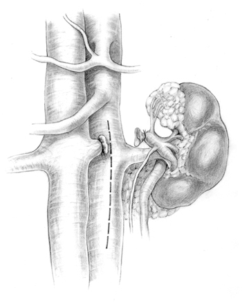Rozległa fenestracja poprzez udrożnienie aorty oraz tętnic nerkowych jako doraźne postępowanie wostrym piersiowo-brzusznym rozwarstwieniu aorty typu Stanford B powikłanym niedokrwieniem nerki ikończyny dolnej