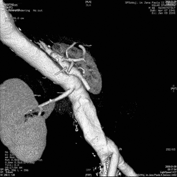 Rozległa fenestracja poprzez udrożnienie aorty oraz tętnic nerkowych jako doraźne postępowanie wostrym piersiowo-brzusznym rozwarstwieniu aorty typu Stanford B powikłanym niedokrwieniem nerki ikończyny dolnej