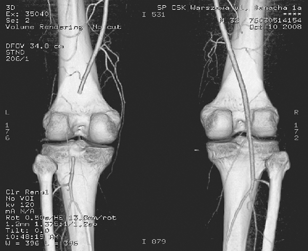 Adventitial cystic degeneration of the popliteal artery as aseldom cause of lower leg ischemia at ayoung age