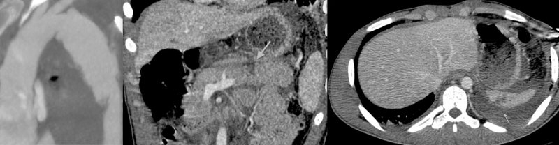 Endovascular repair of traumatic thoracic aortic pseudoaneurysm combined with simultaneous distal pancreatectomy due to the pancreas body rupture – case report and review of literature