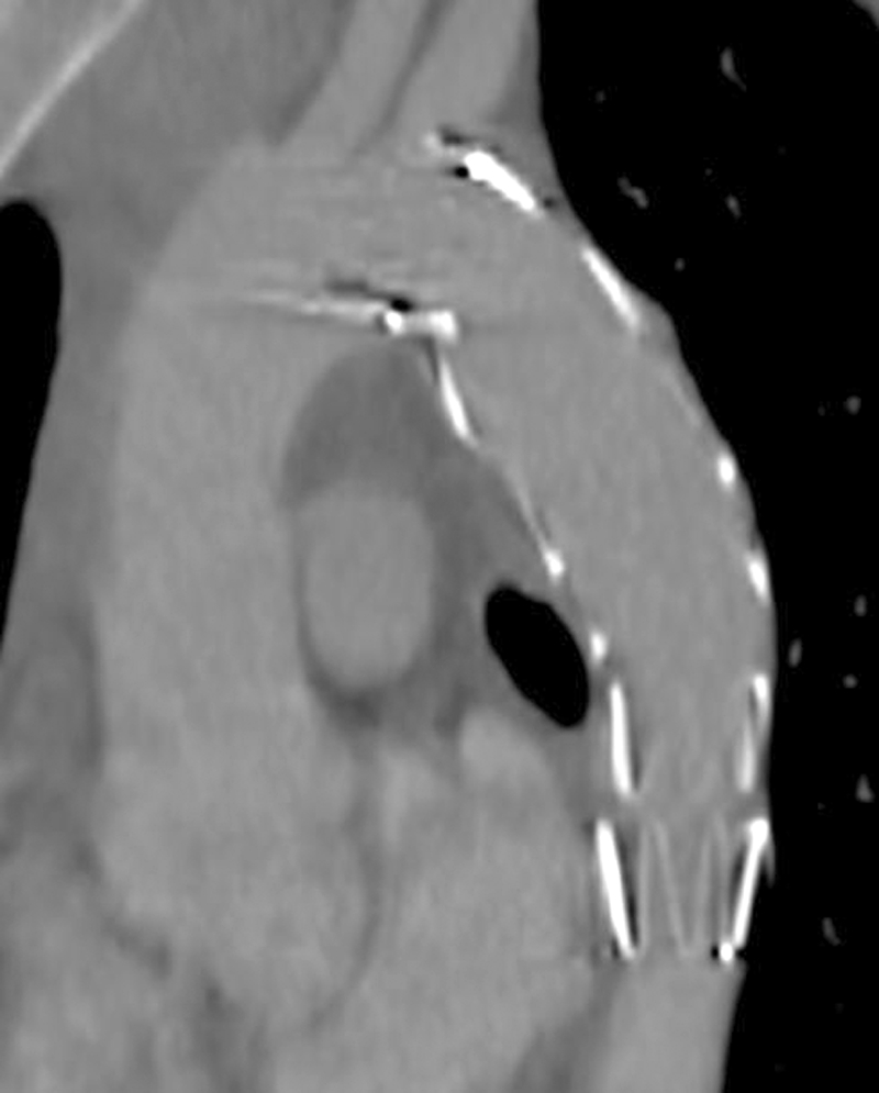 Endovascular repair of traumatic thoracic aortic pseudoaneurysm combined with simultaneous distal pancreatectomy due to the pancreas body rupture – case report and review of literature