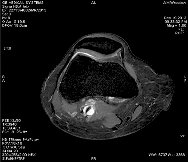 Cystic adventitial disease of the popliteal artery in ayoung woman – acase report