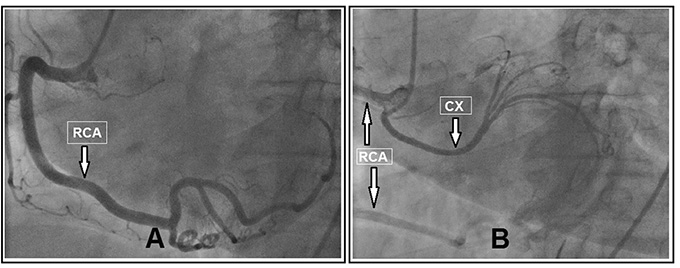 Arare coronary anomaly: all main coronary arteries originating from right sinus of Valsalva with separate ostium