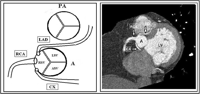 Arare coronary anomaly: all main coronary arteries originating from right sinus of Valsalva with separate ostium