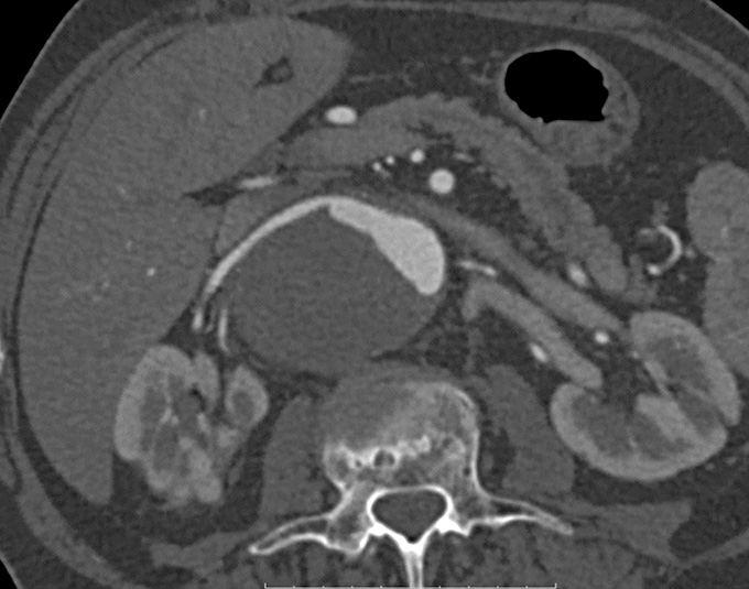 Application of Zenith t-Branch system in symptomatic thoracoabdominal aortic aneurysm with unfavourable anatomy – case report