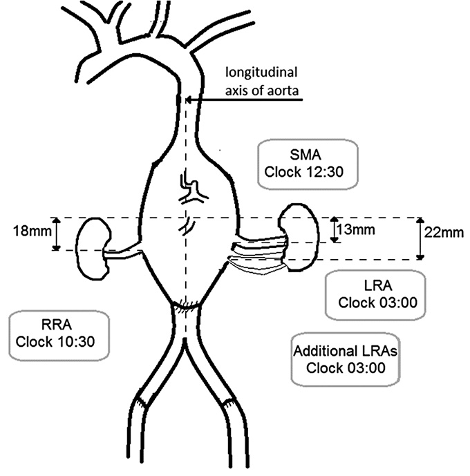 Application of Zenith t-Branch system in symptomatic thoracoabdominal aortic aneurysm with unfavourable anatomy – case report