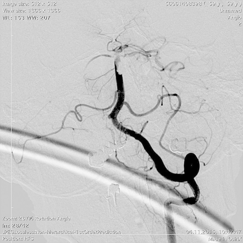 Embolism of the basilar artery – comprehensive treatment including mechanical thrombectomy