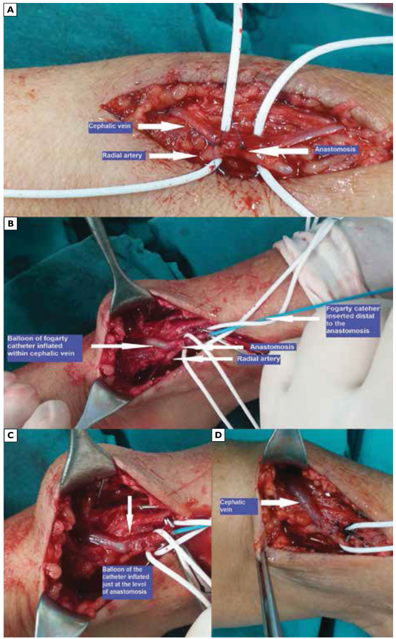 Fogarty® catheter dilatation of veins smaller than 2.5 mm after completion of the anastomosis during arteriovenous fistula creation