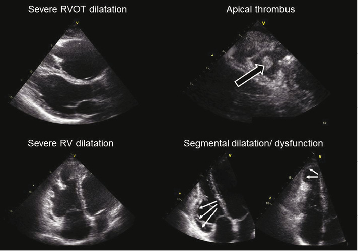 Arrhythmogenic Right Ventricular Cardiomyopathy Cardiac MRI, 44% OFF