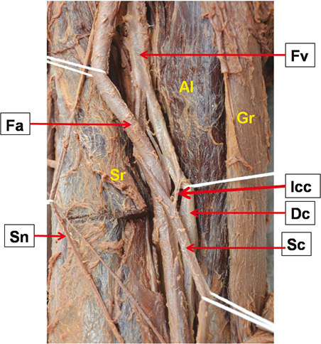 An interconnected duplicated femoral vein and its clinical significance