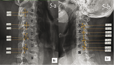 Morphological and radiometrical study of the human intervertebral