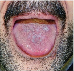 Diagnostyka Stanow Przedrakowych Blony Sluzowej Jamy Ustnej Walter Forum Medycyny Rodzinnej