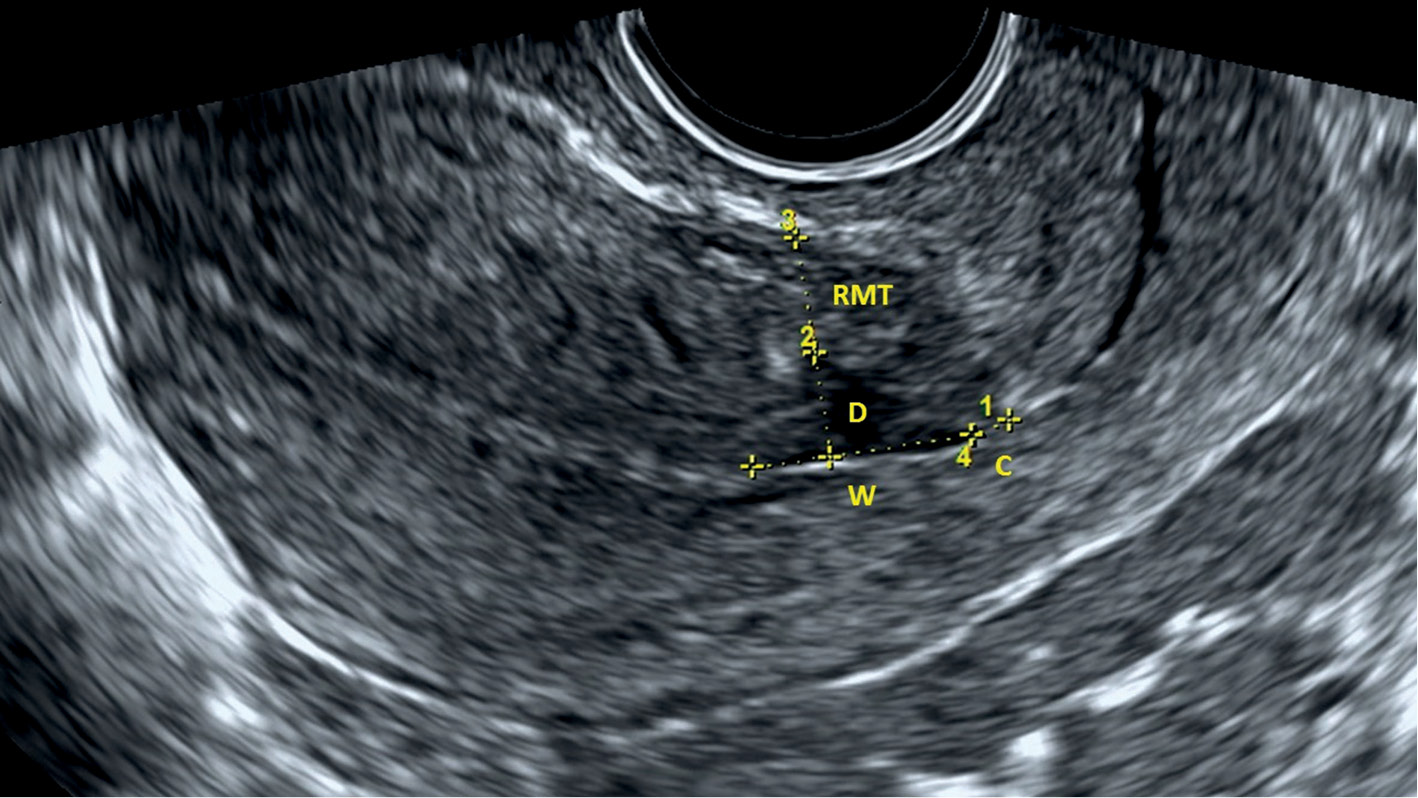Morphology of the cesarean section scar in the non-pregnant uterus