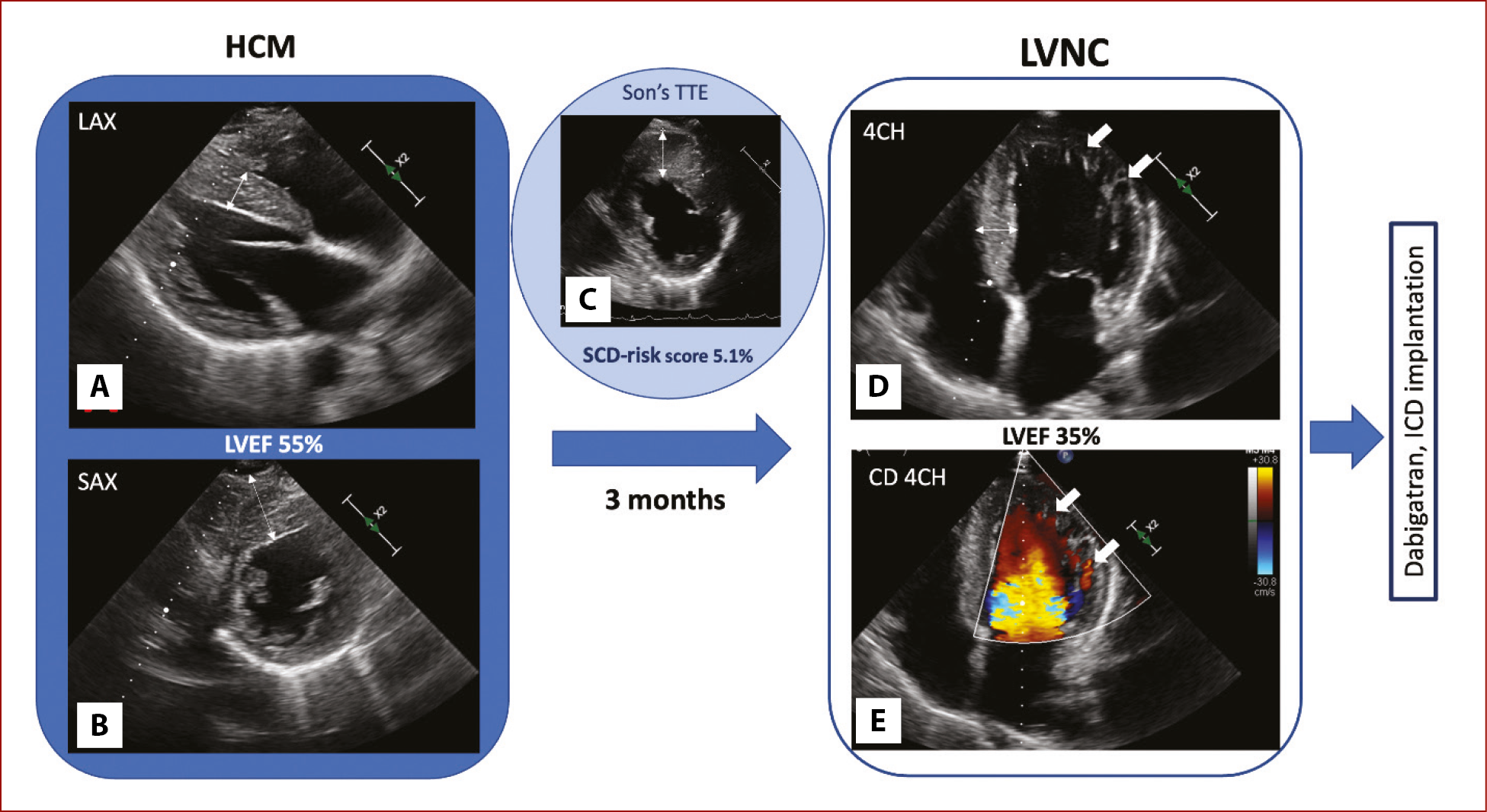 Hypertrophic cardiomyopathy, non-compaction cardiomyopathy or non ...