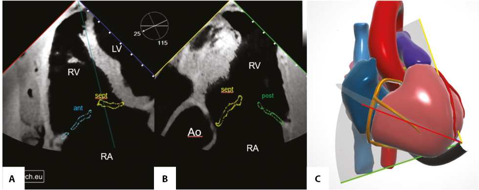 Percutaneous tricuspid edge-to-edge repair — patient selection, imaging ...