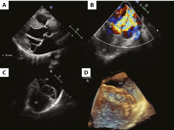 Echocardiography imaging of mitral annulus disjunction in a young ...