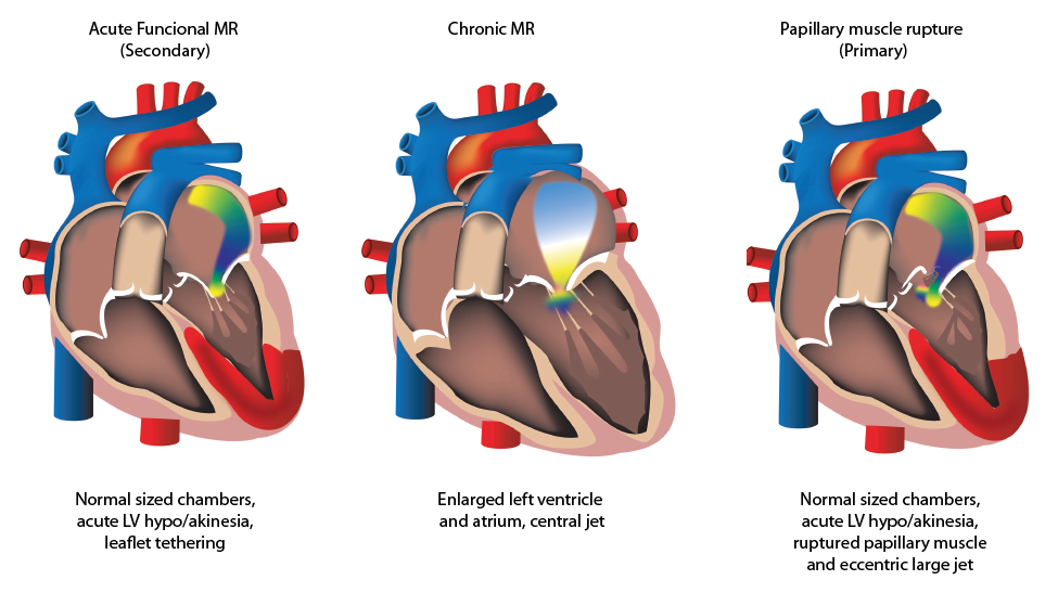 Transcatheter edgetoedge repair in acute mitral regurgitation