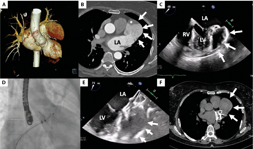 Transcatheter Closure Of A Giant Left Atrial Appendage Aneurysm | Streb ...