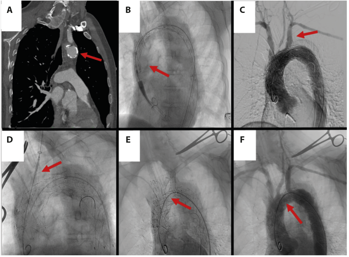 Total Endovascular Repair Of An Aortic Arch Using A Triple-branched ...