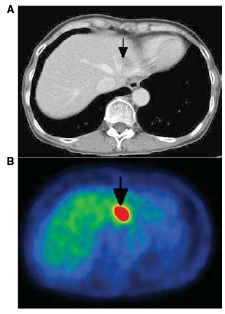 Imaging patterns of liver uptakes on PET scan: pearls and pitfalls