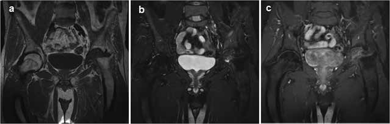 99mTc(V)-DMSA SPECT-CT findings in a case of Gorham-Stout disease ...