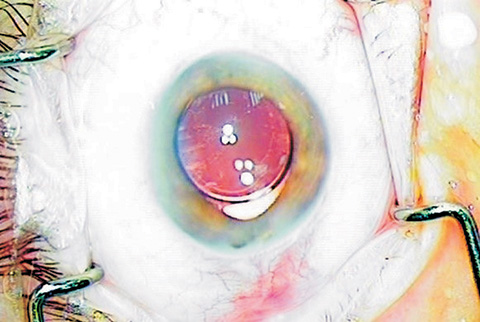 Broken intraocular lens haptic during cataract surgery