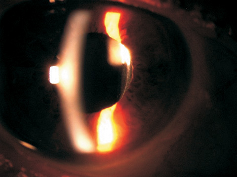 Broken intraocular lens haptic during cataract surgery