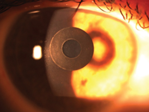 Kamra corneal inlay for the correction of presbyopia
