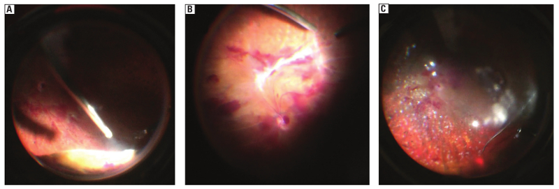 Outcomes of vitrectomy in severe complications of proliferative diabetic retinopathy