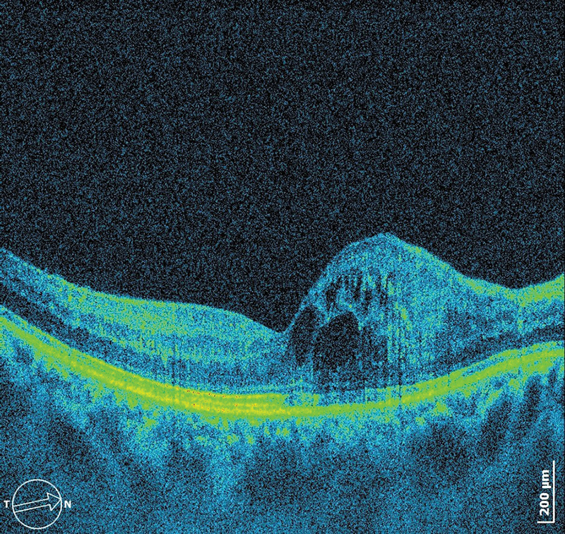 Intravitreal anti-VEGF therapy in macular oedema secondary to racemose haemangiomatosis of the retina