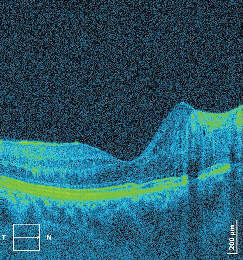 Intravitreal anti-VEGF therapy in macular oedema secondary to racemose haemangiomatosis of the retina