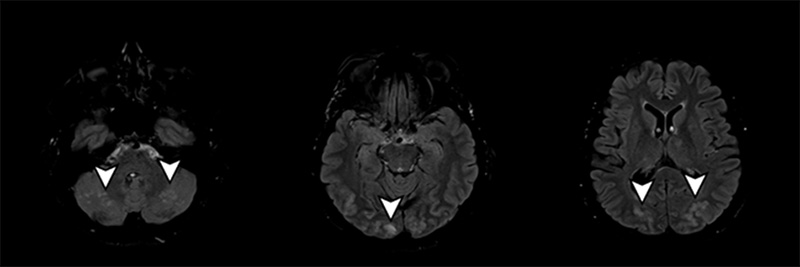 Vision deterioration in posterior reversible encephalopathy syndrome (PRES)